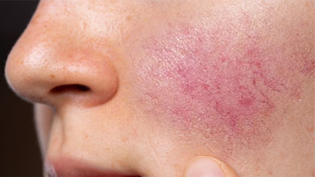 What is Post Inflammatory Hyperpigmentation? How can we treat Post Inflammatory